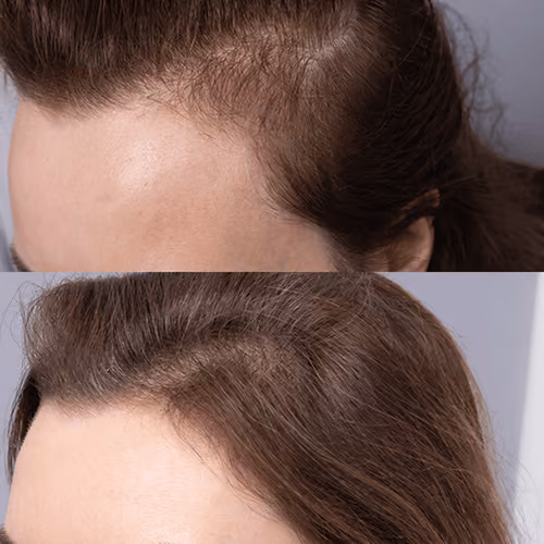 Before and after female hair transplant results showing improved hairline density and natural hair growth.