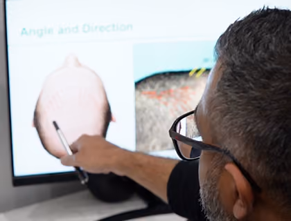 Hair transplant specialist explaining graft angle and direction on a digital screen