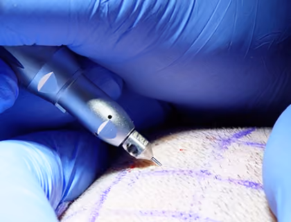 Hair transplant patient having donor area shaved before FUE procedure