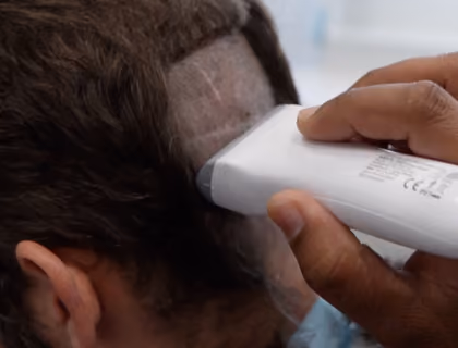 FUE hair transplant graft extraction from the scalp using a surgical punch tool