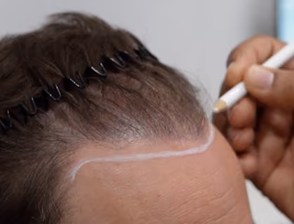 Patient having their hairline marked before a hair transplant procedure