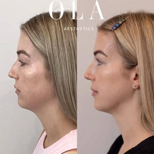Before,After