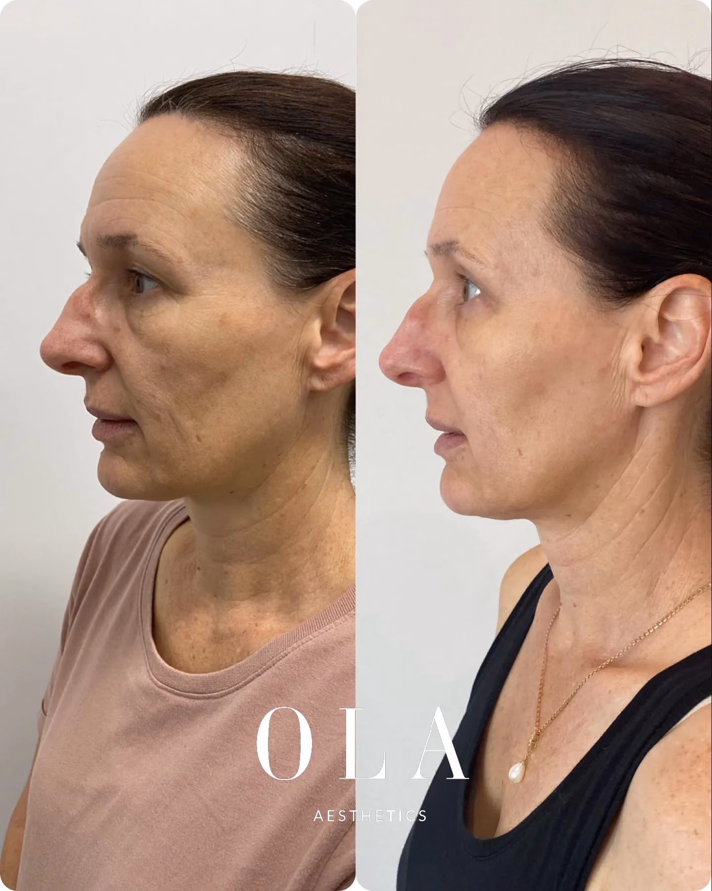 Side-by-Side Before and After