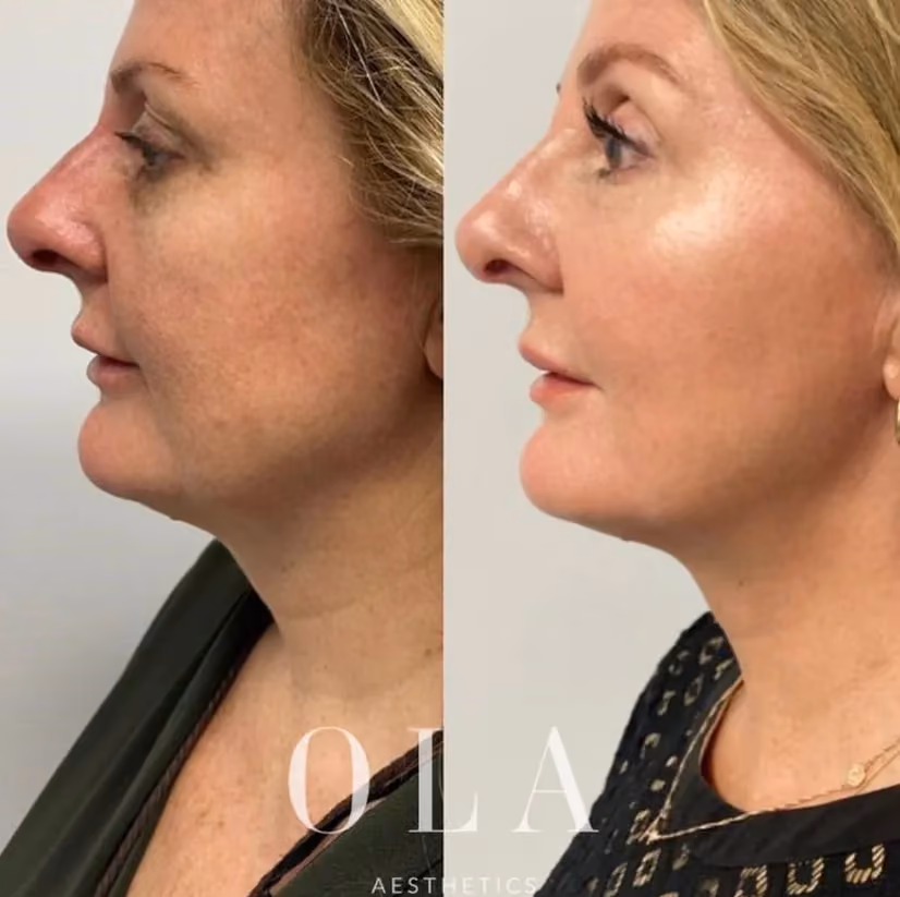 Side-by-Side Before and After