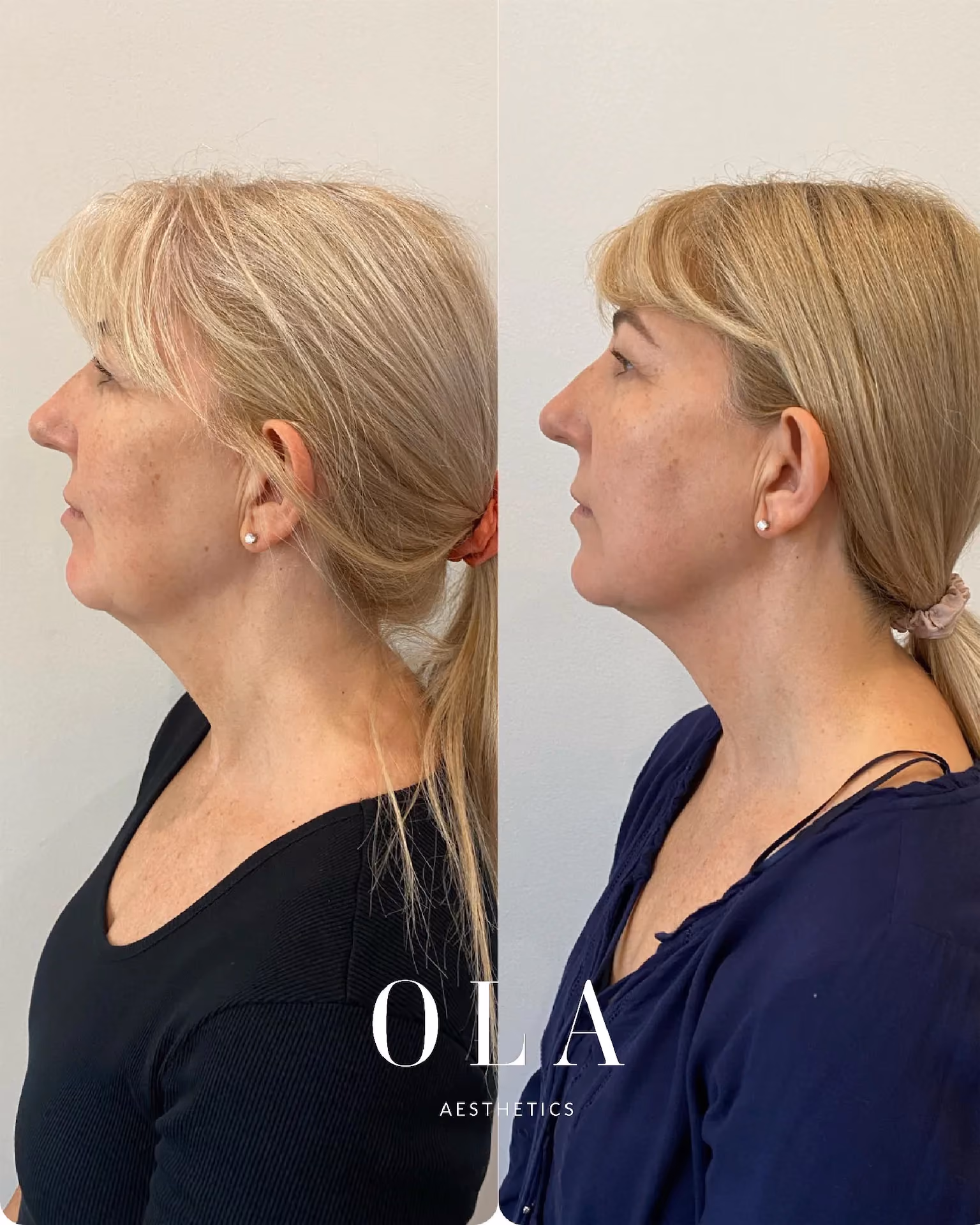 Side-by-Side Before and After