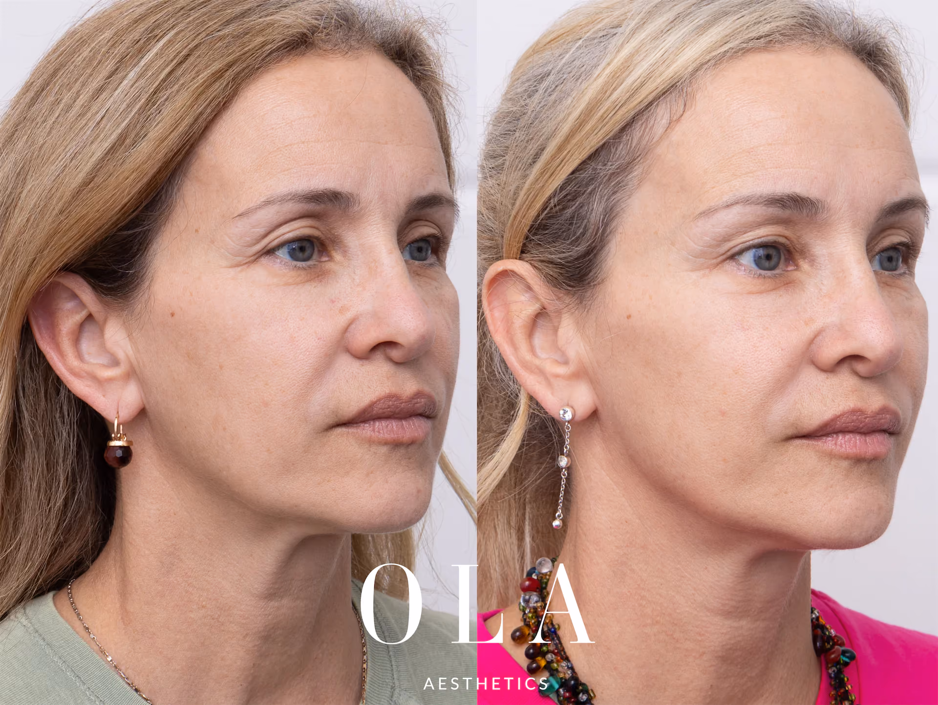 Side-by-Side Before and After