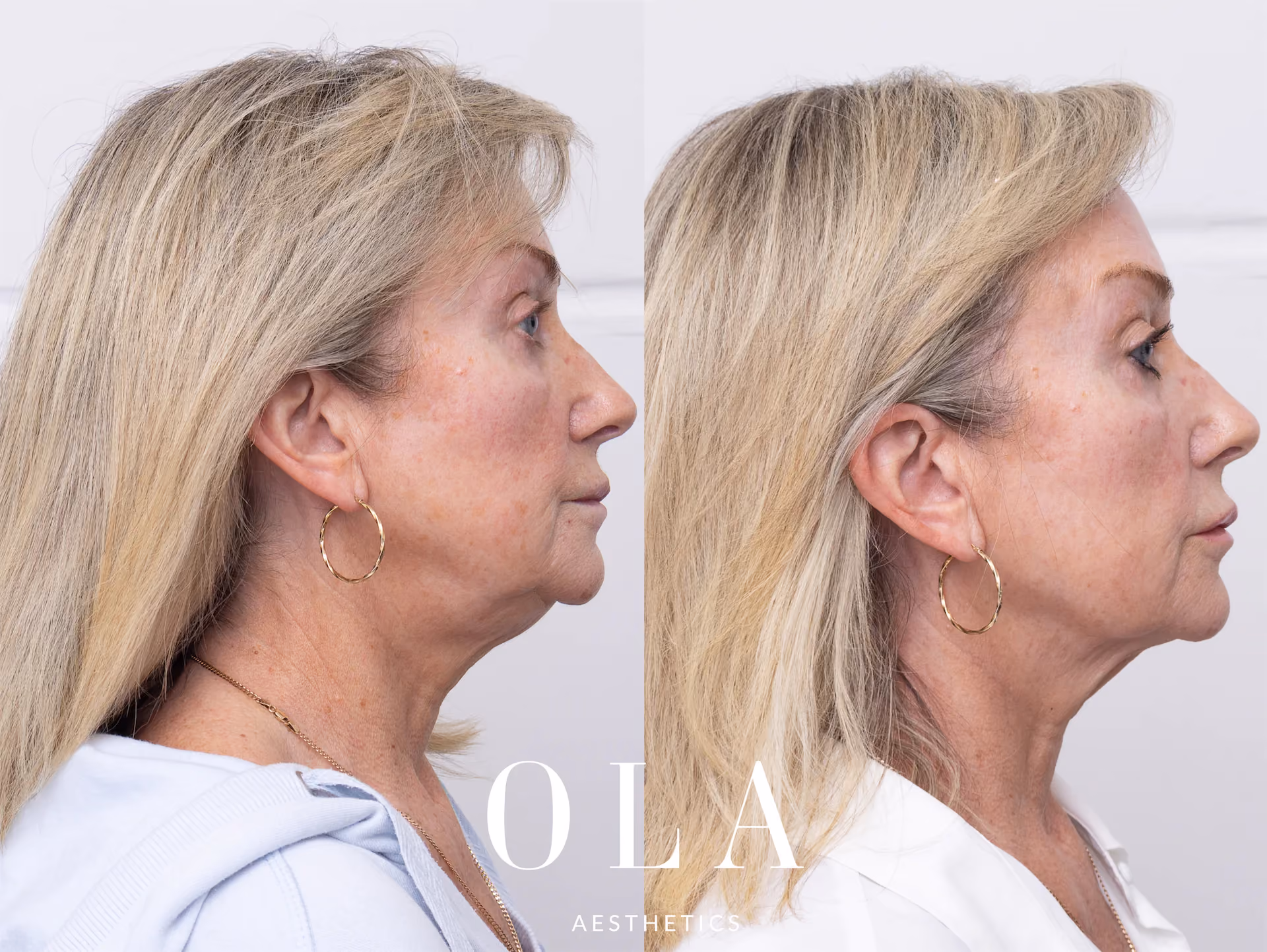Side-by-Side Before and After