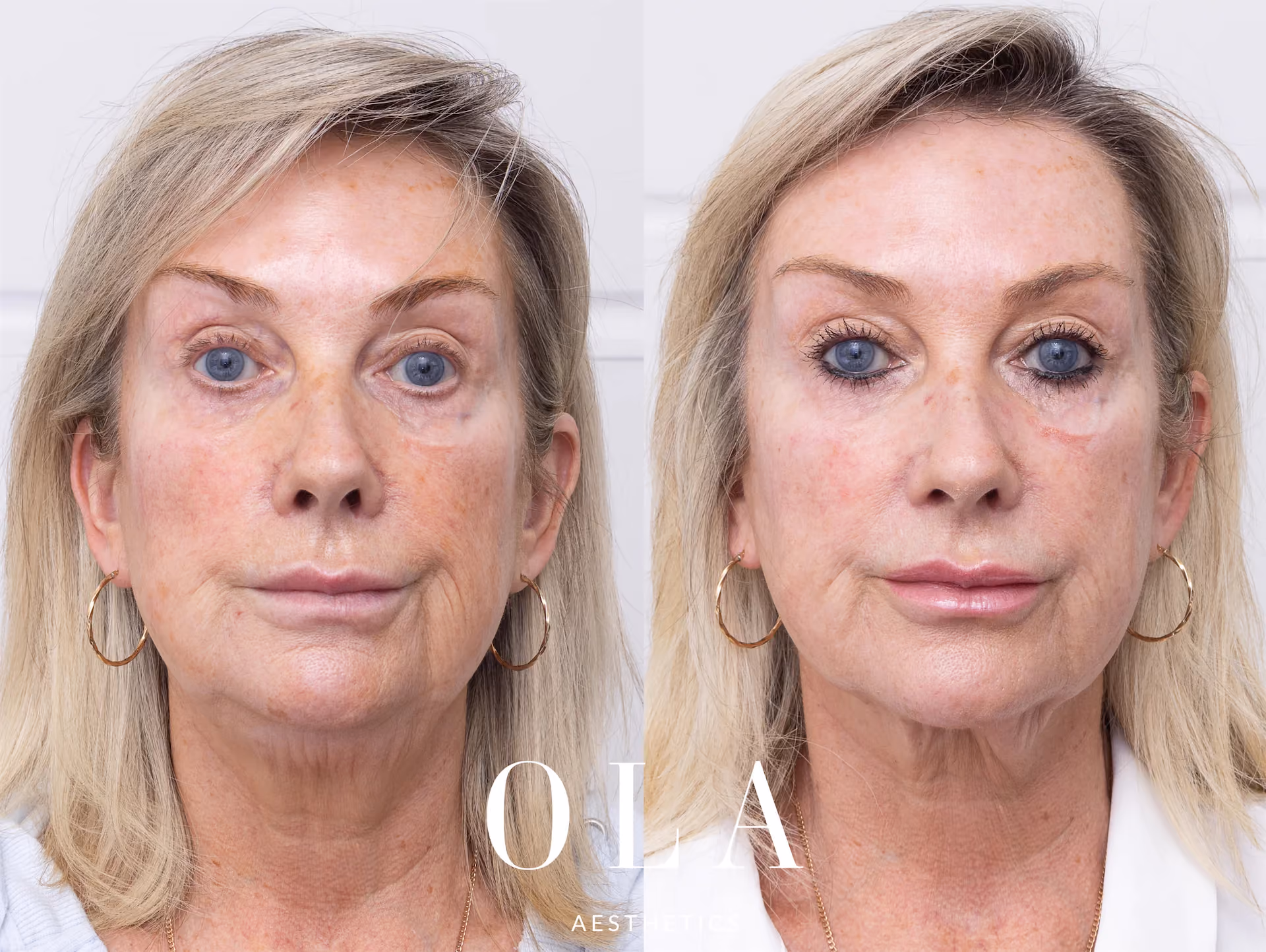 Side-by-Side Before and After