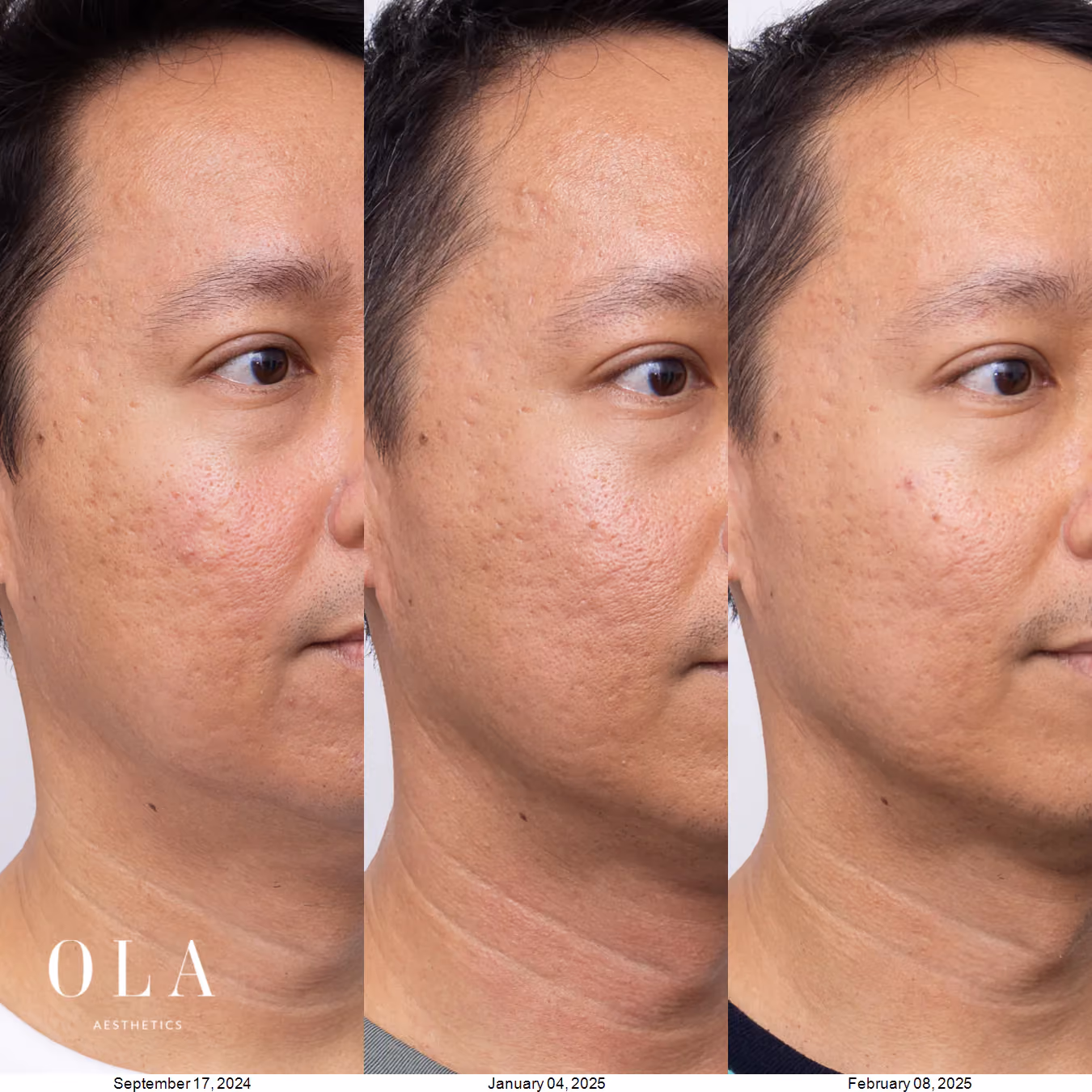 Treatment Progression