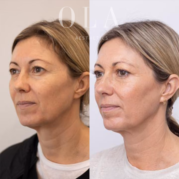 Side-by-Side Before and After