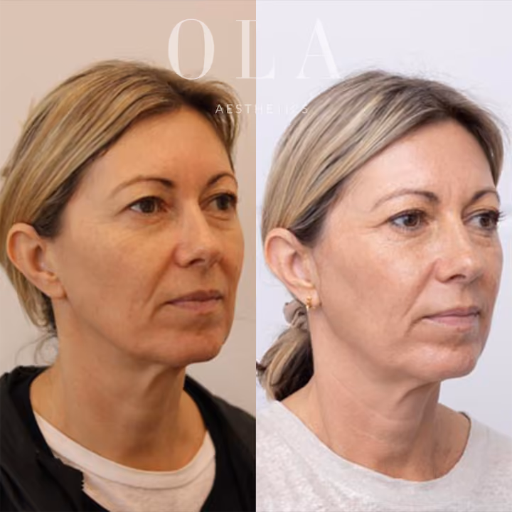 Side-by-Side Before and After