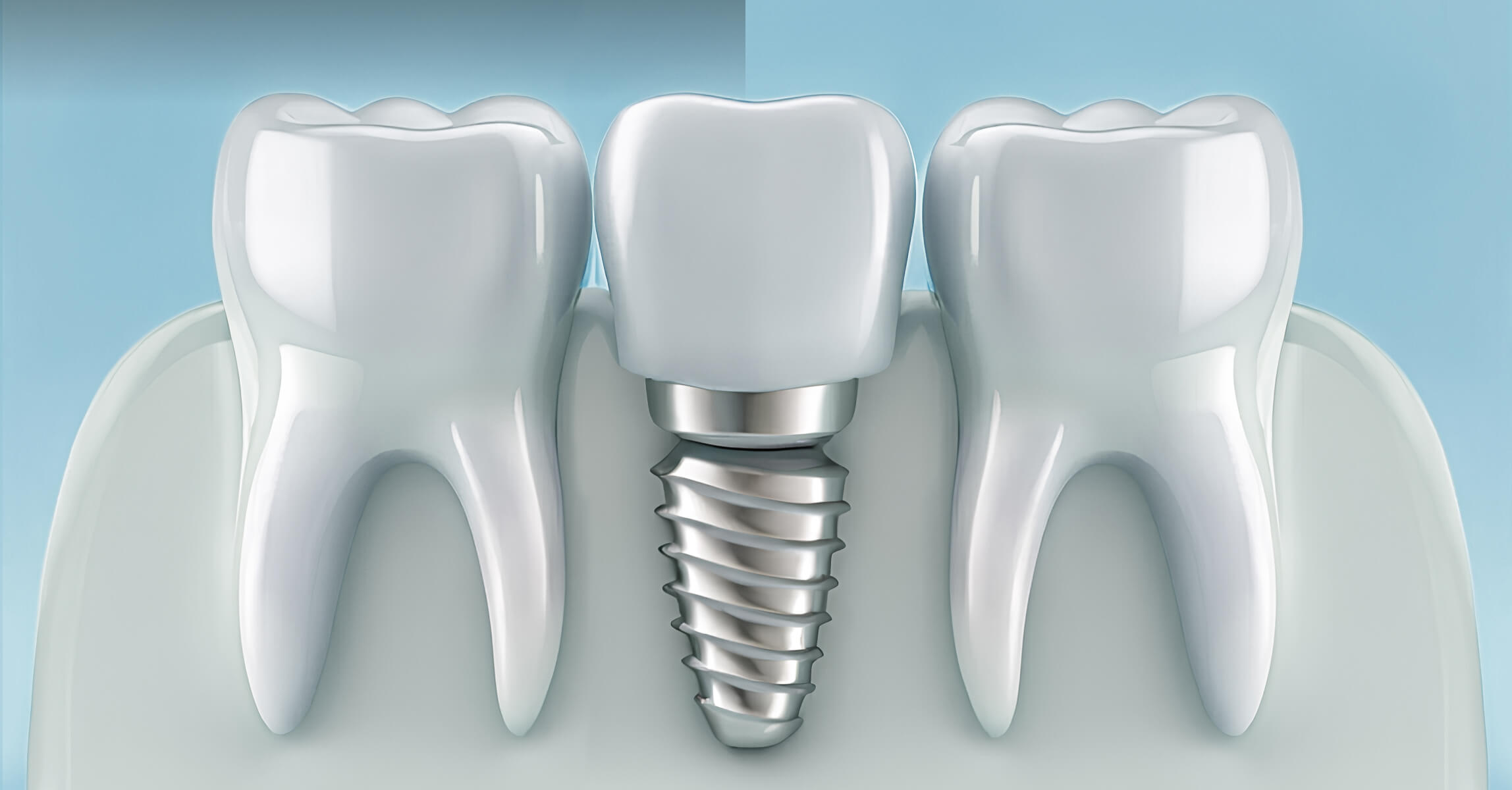 Implantes dentários: o que são e como funcionam
