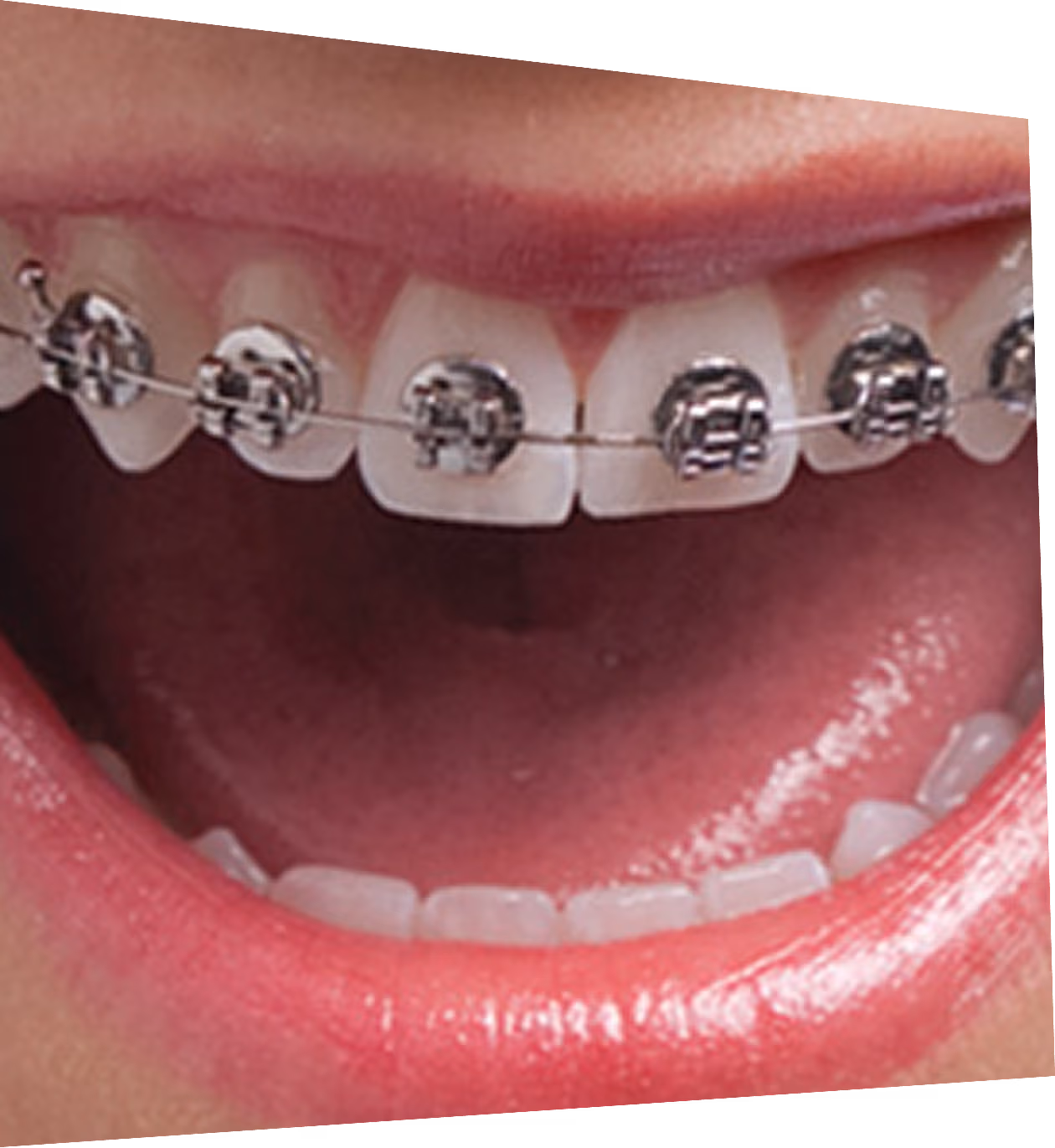 Before and after of patients teeth