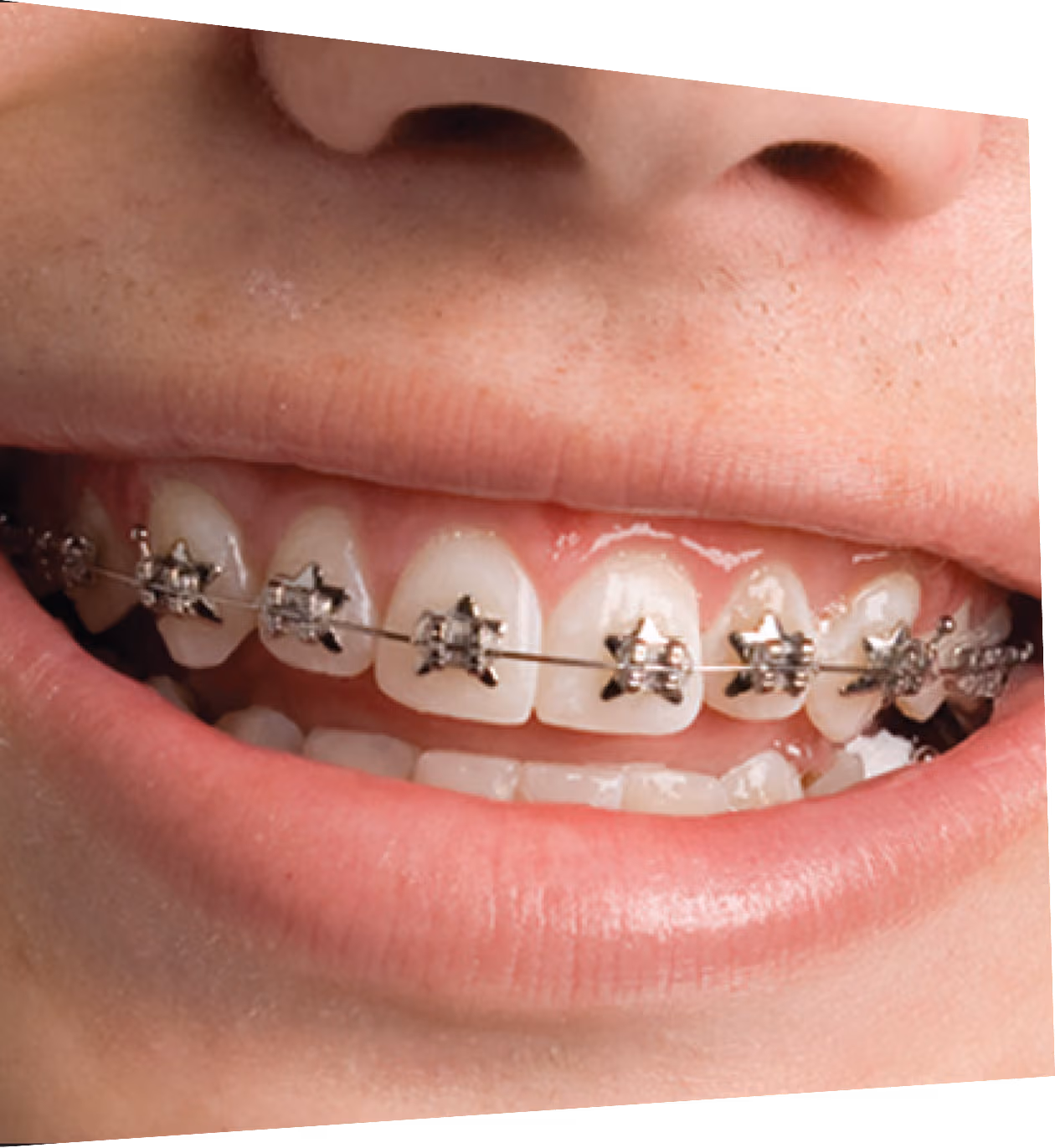 Before and after of patients teeth