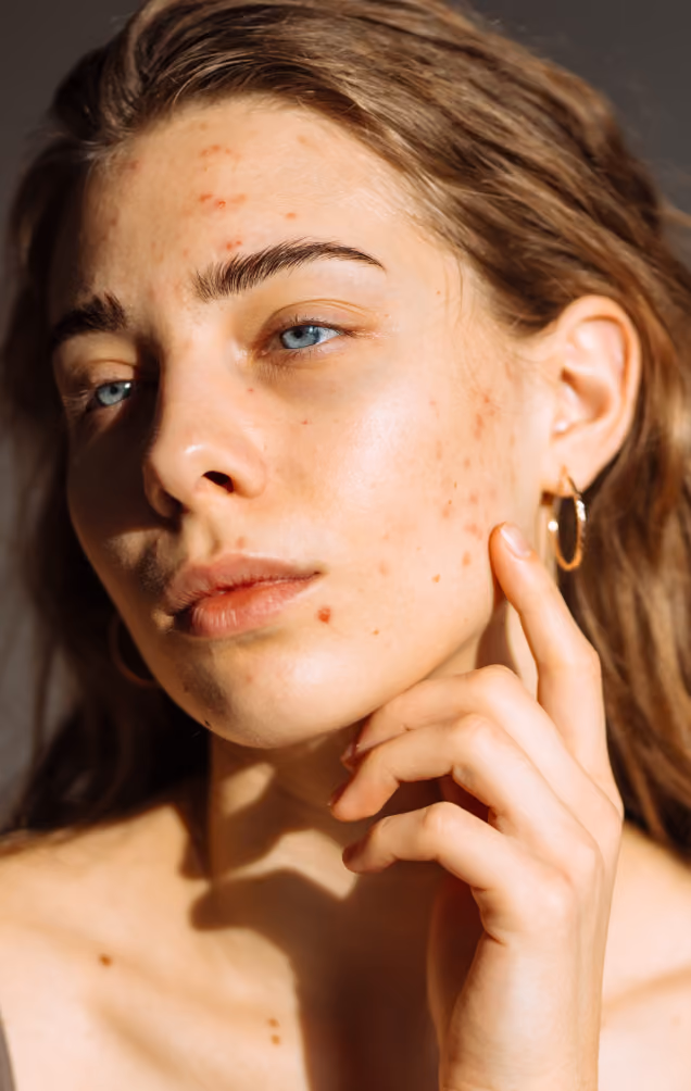 A person showing her acne 