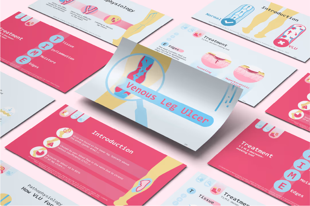 Venous leg ulcer PowerPoint presentation for clinical wound care featuring venous insufficiency diagrams, treatment visuals, and medical education slides