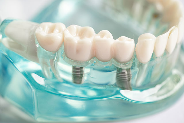 dental implants, dental implants Crown Point, dental implant cost Crown Point, are dental implants worth it