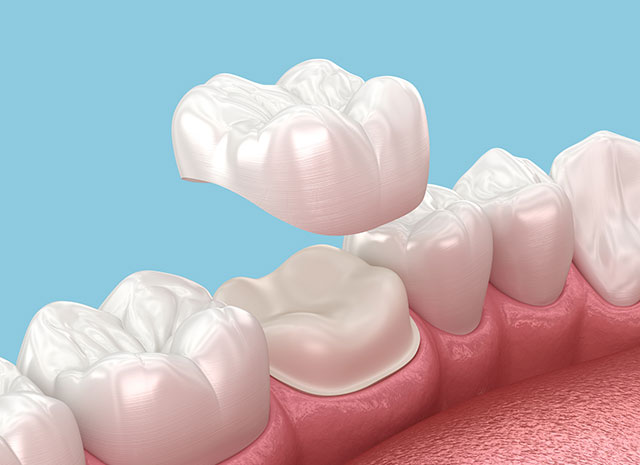 dental crowns, dental crowns Crown Point, restorative dentistry Crown Point, when do you need a dental crown