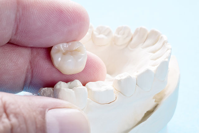 What is the difference between a traditional and same-day crown? A Crown Point dentist answers.