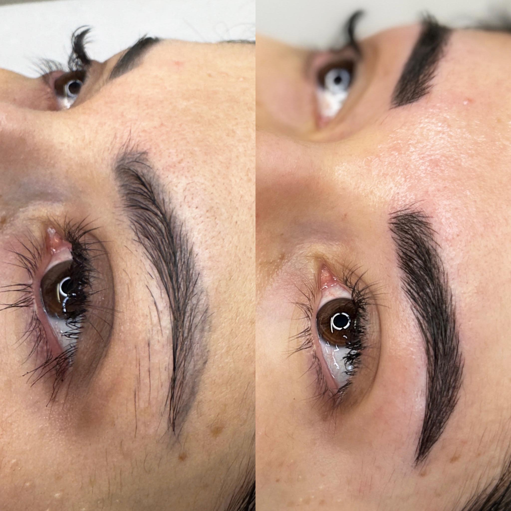 Entfernen alter PMU-Arbeiten – sanfte Korrekturmethoden in München.