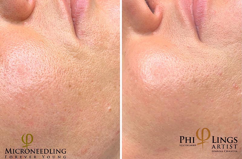 Entfernen alter PMU-Arbeiten und Microneedling– sanfte Korrekturmethoden in München.