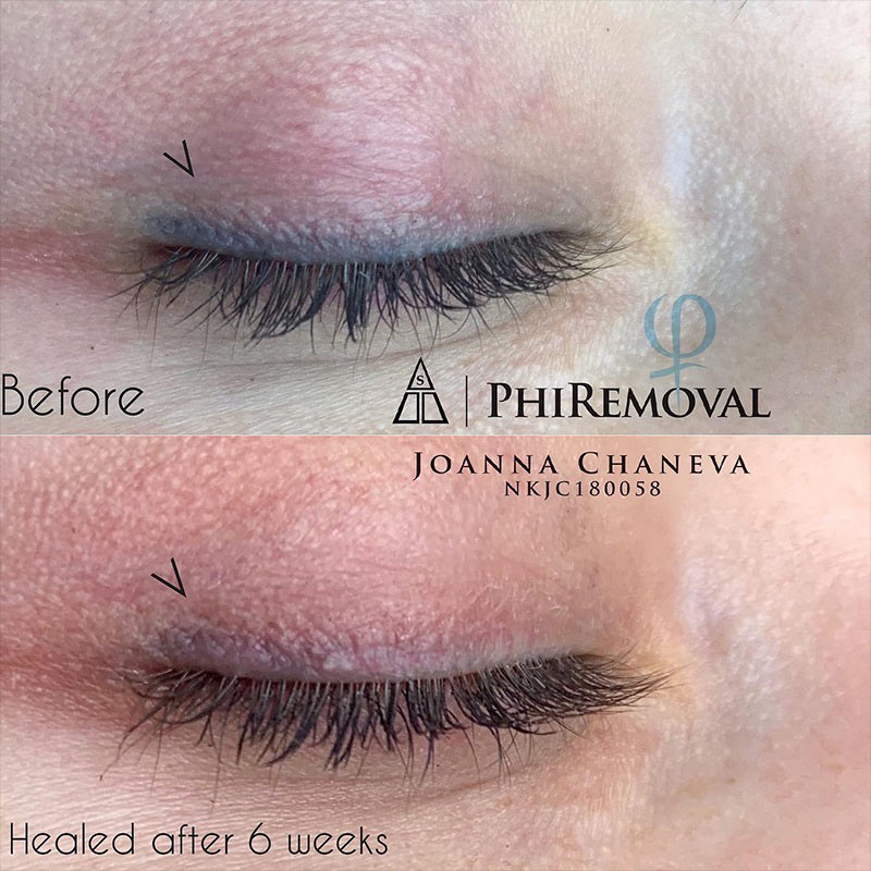 Microblading Entfernung ohne Laser