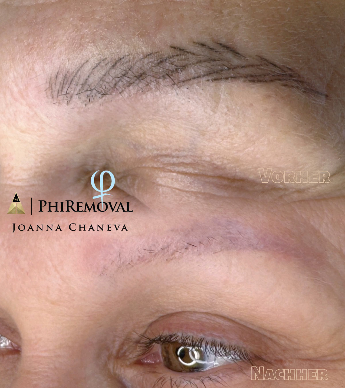 PhiRemoval Behandlung bei Joanna Chaneva