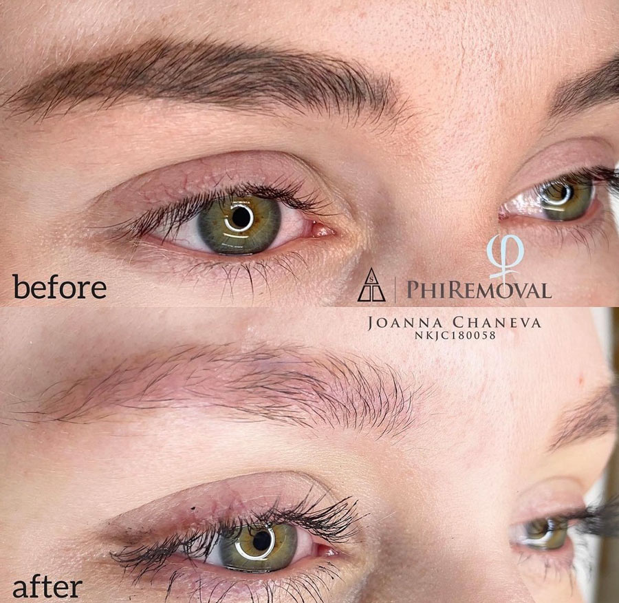 Entfernen alter PMU-Arbeiten – sanfte Korrekturmethoden in München.