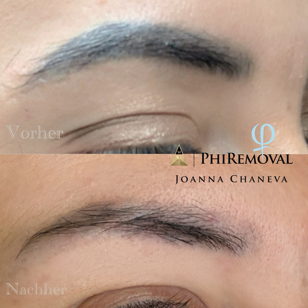 PMU Korrektur München Vorher Nachher