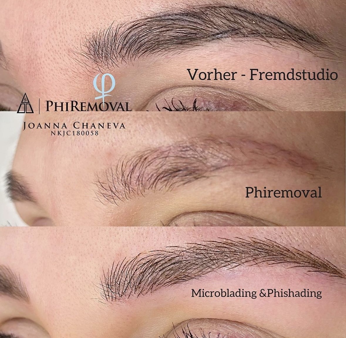 Misslungenes Microblading entfernen München