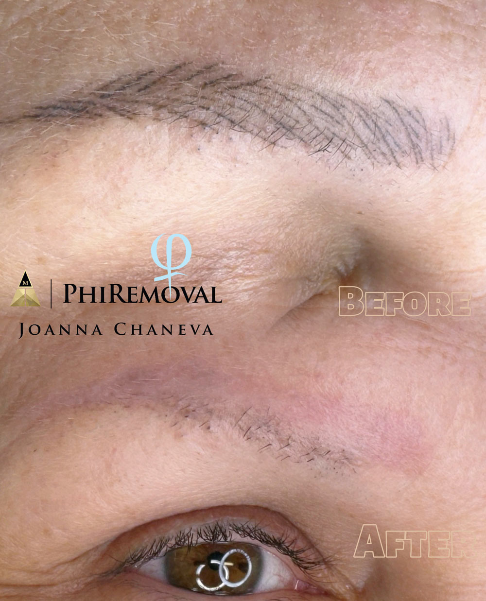 Lippen Permanent Make-up und Augenbrauen Entfernung