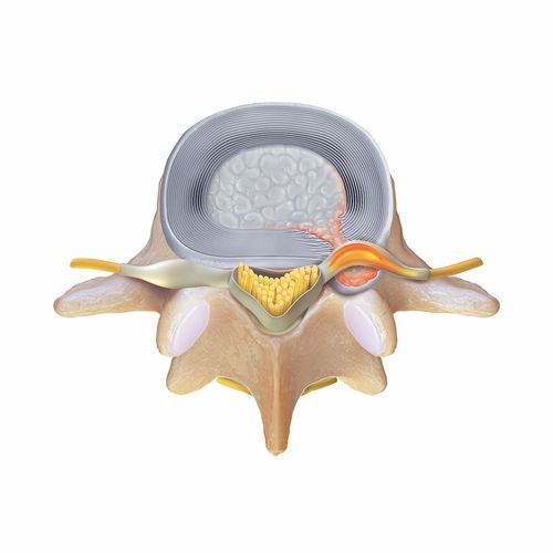 Contained disc herniation