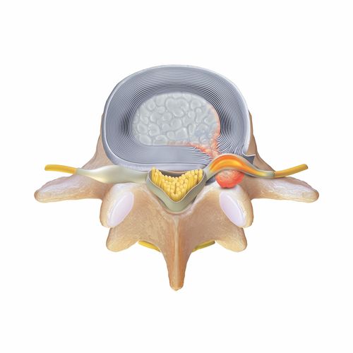 Extruded disc herniation