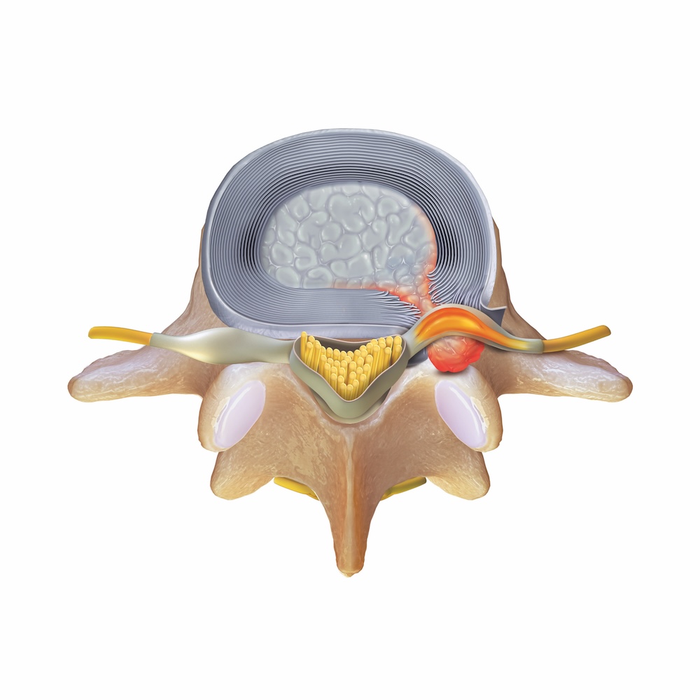 Extruded disc herniation