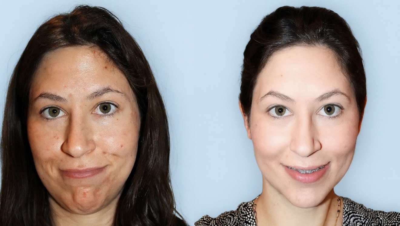 Before and After Pigmentation Treatment