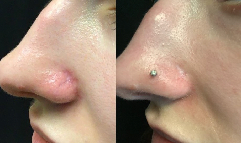 Spider Veins Laser Treatment Before and After