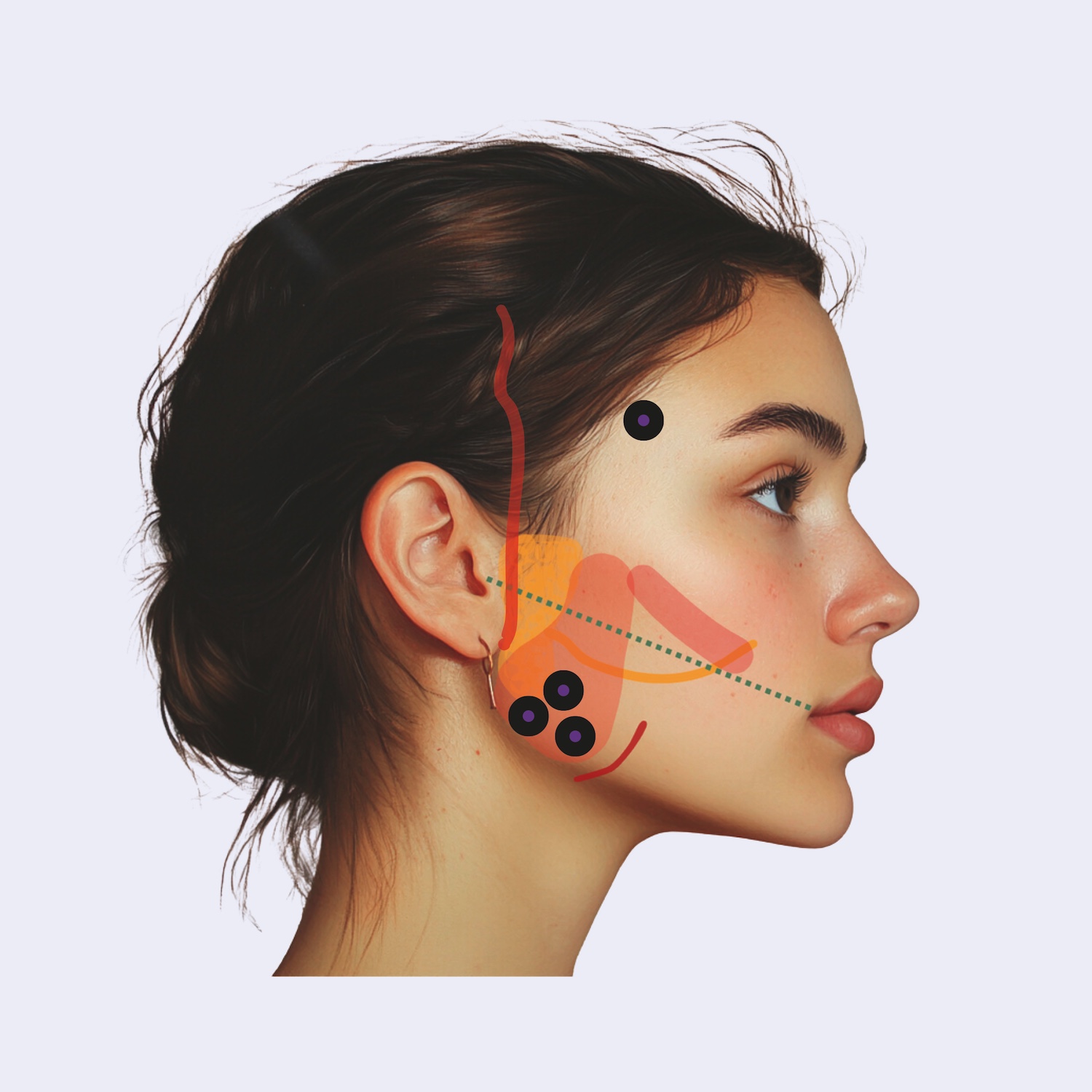 Profil einer Frau mit zurückgebundenem dunklem Haar, das die anatomische Überlagerung der Gesichtsmuskeln und die Injektionspunkte in der Nähe des Kiefers und der Schläfen zeigt und die Anwendung von Botulinumtoxin zur Behandlung von Bruxismus verdeutlicht.