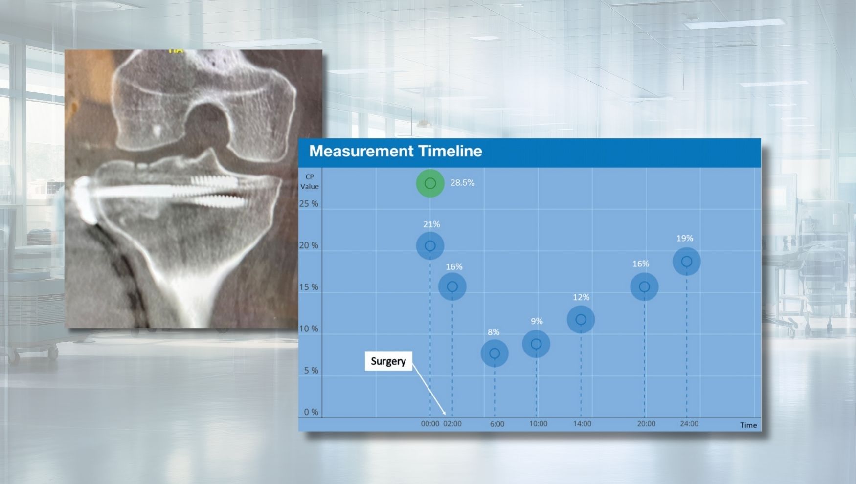 Quantify Soft Tissue: Avoided Prophylactic Fasciotomy