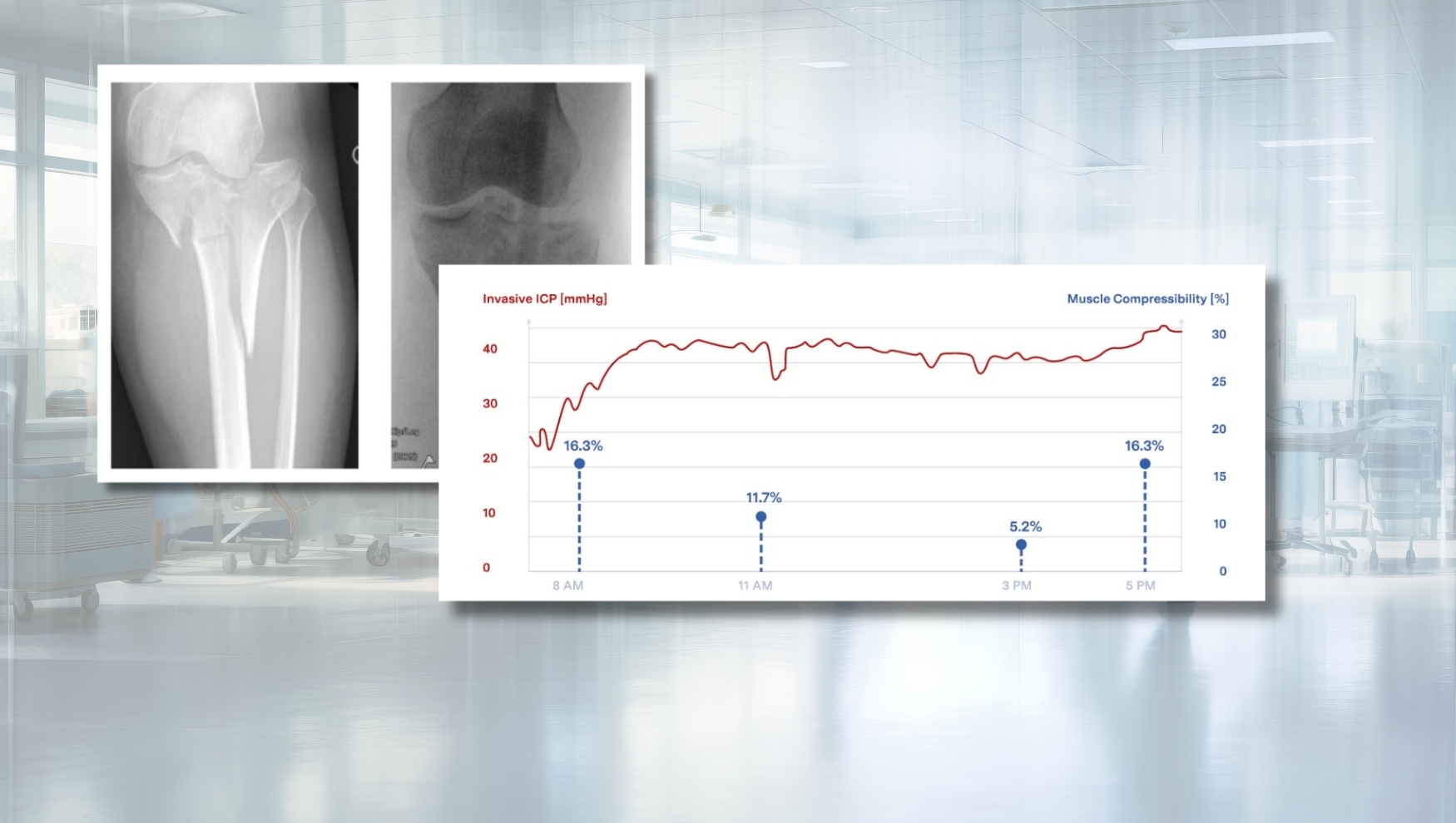 Quantifying Muscle Compressibility as a New Decision Support