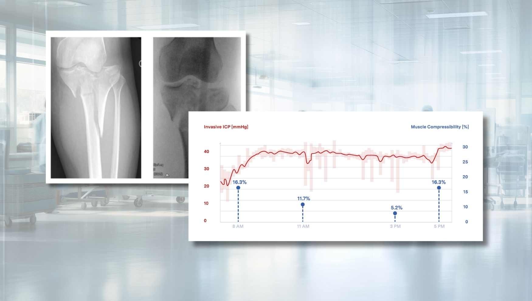 Quantifying Muscle Compressibility as a New Decision Support