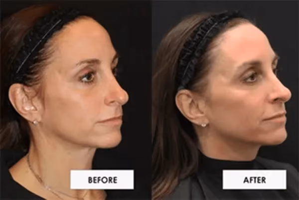 Before and after Sciton Halo