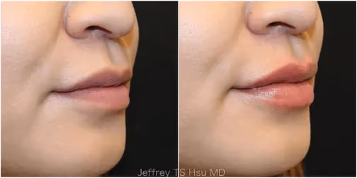 Lip filler before and after