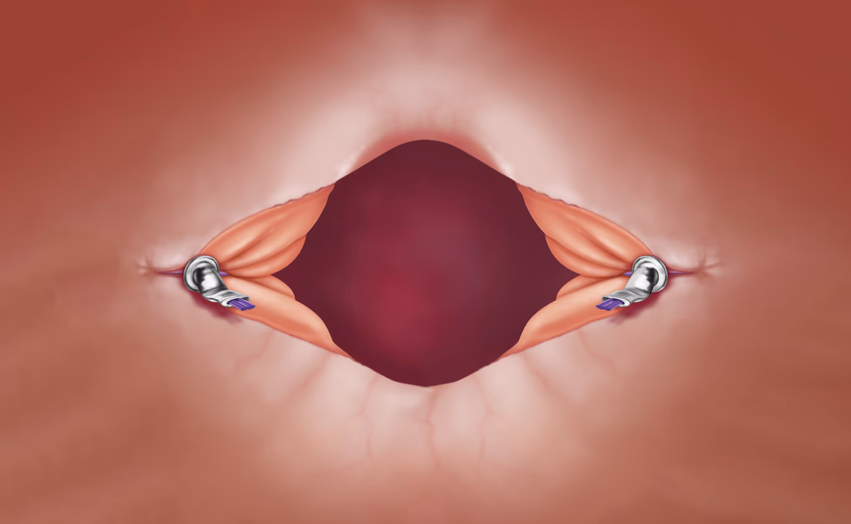 TUITMR Image