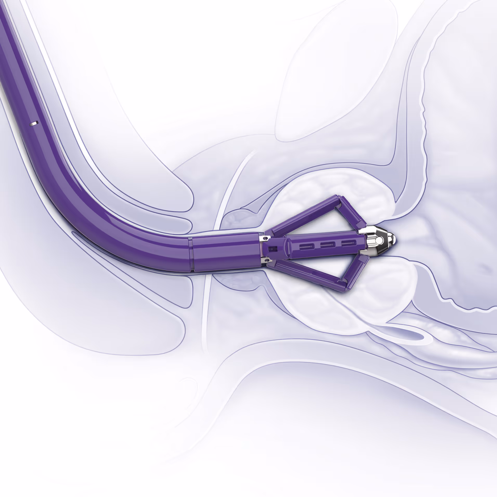 Prostagrip Prostatectomy Image