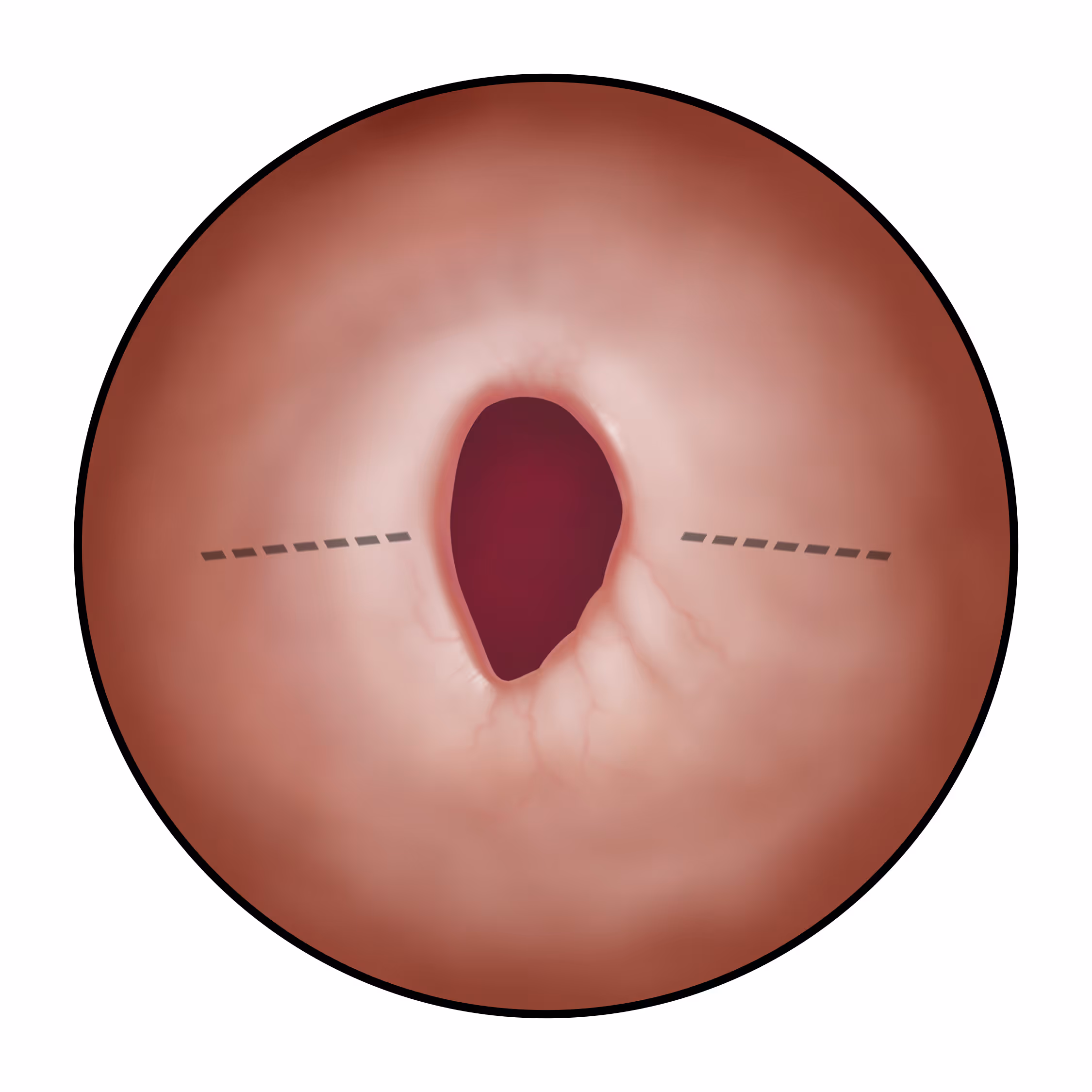 Small Stricture TUIMTR - LSI Solutions