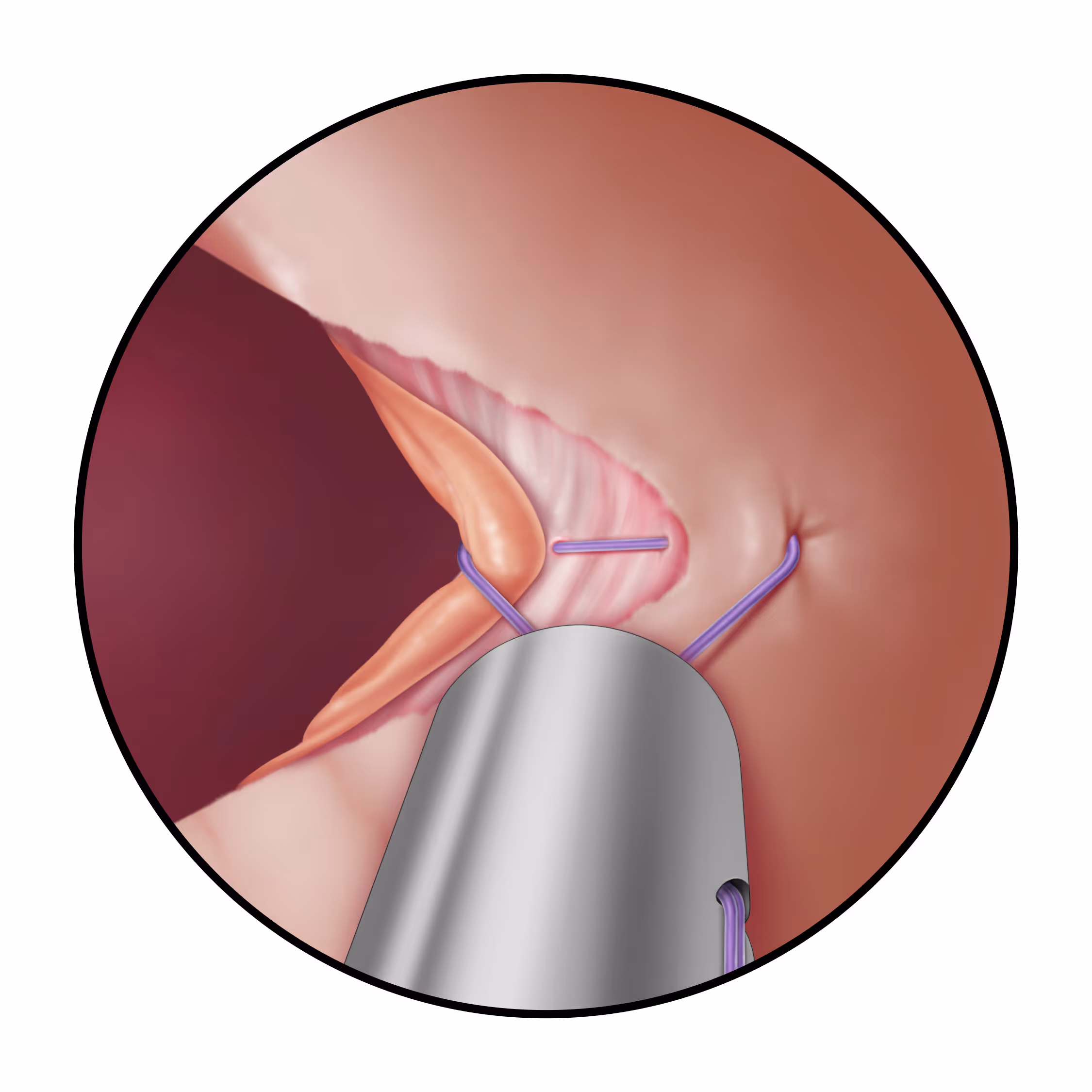 TUITMR Ti-KNOT - LSI Solutions