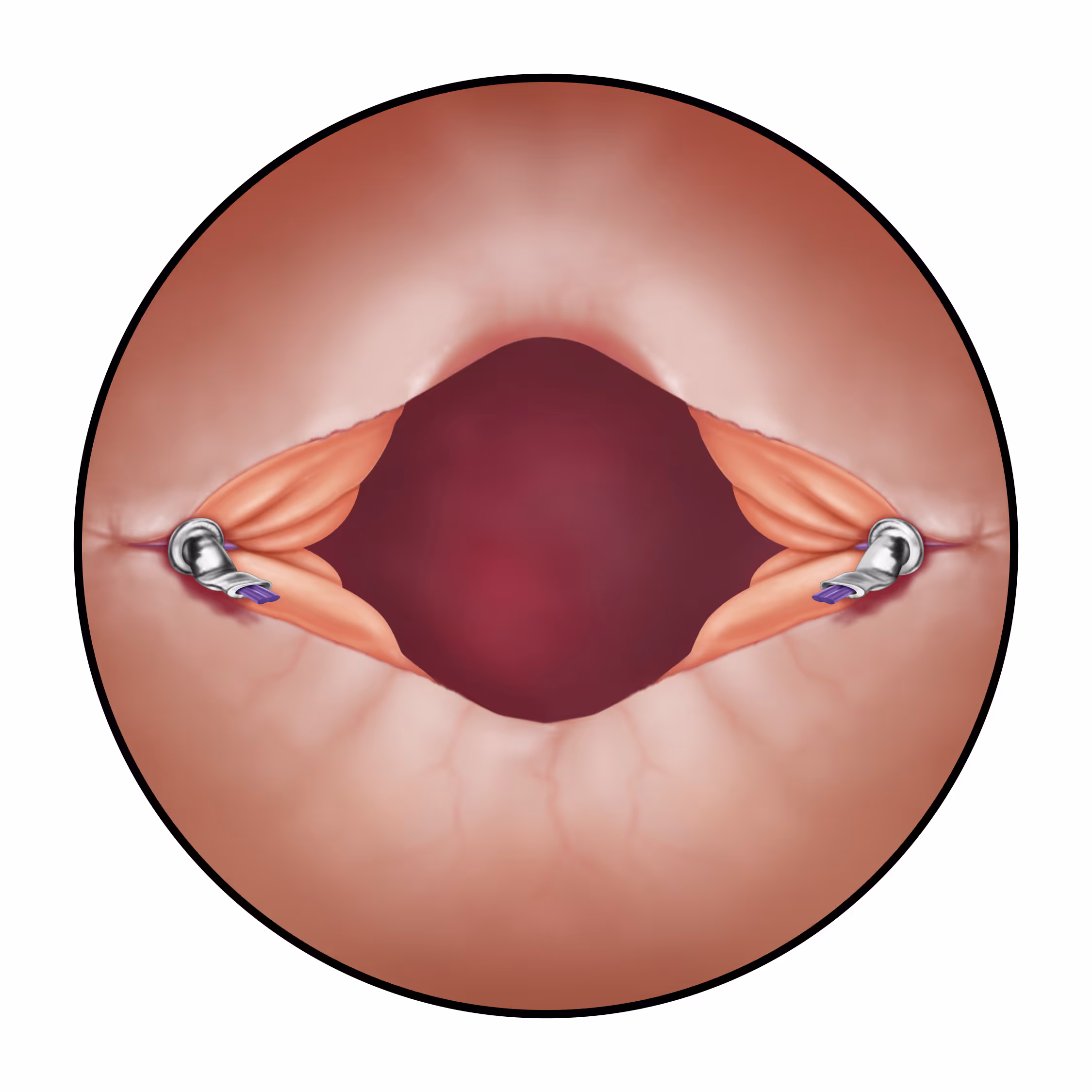 TUITMR Final Ti-KNOT - LSI Solutions