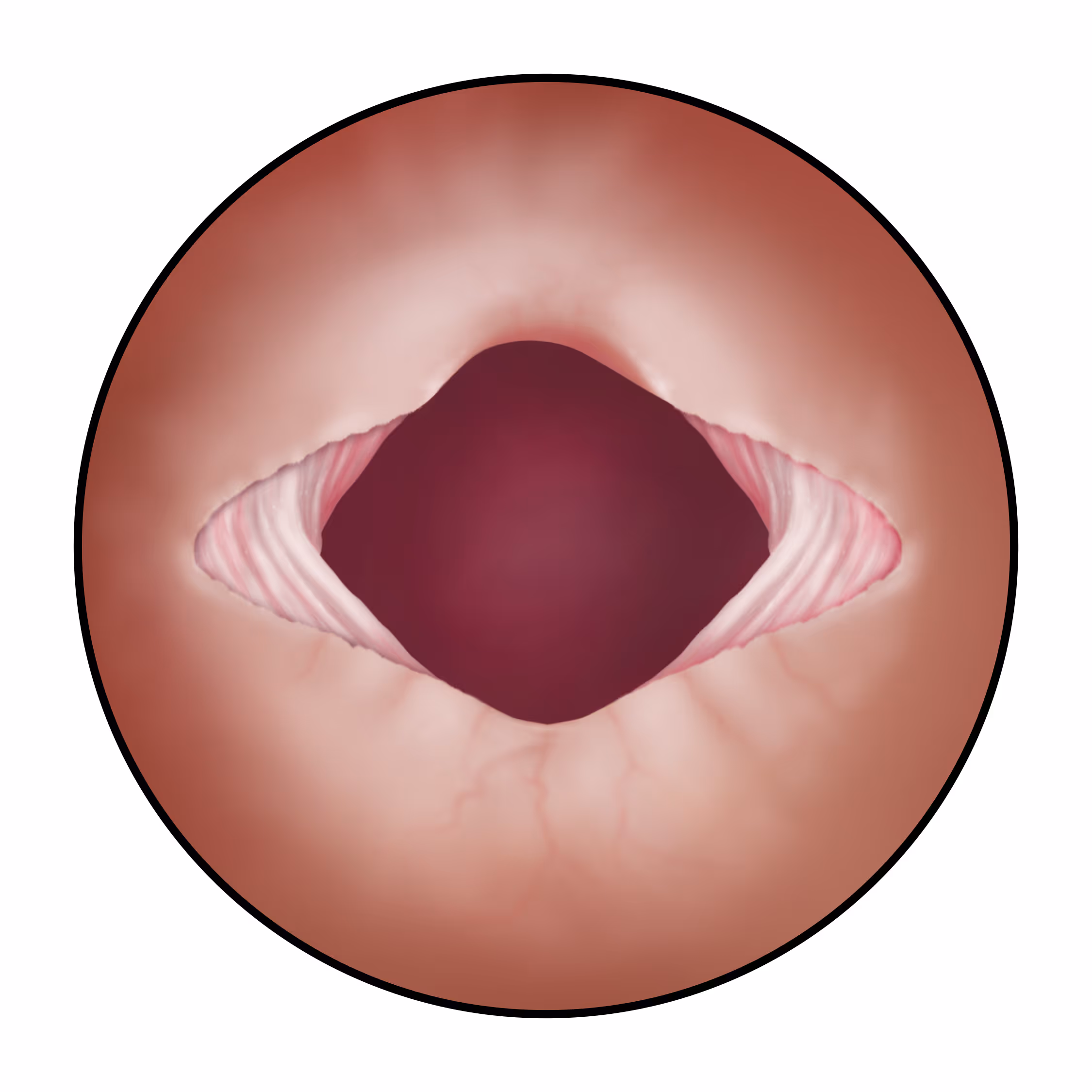 Transverse Mucosal Realignment