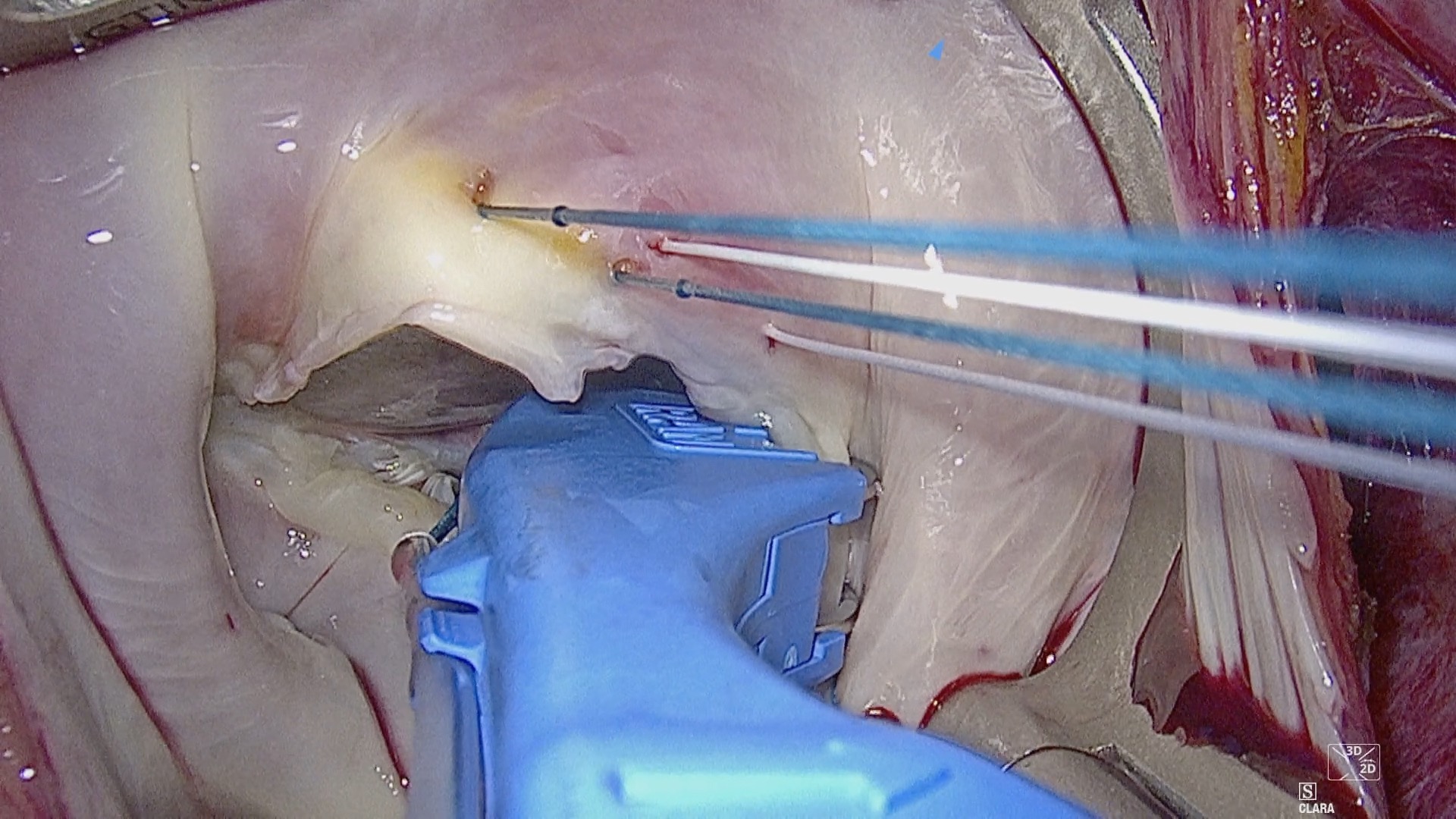 RAM suture placement