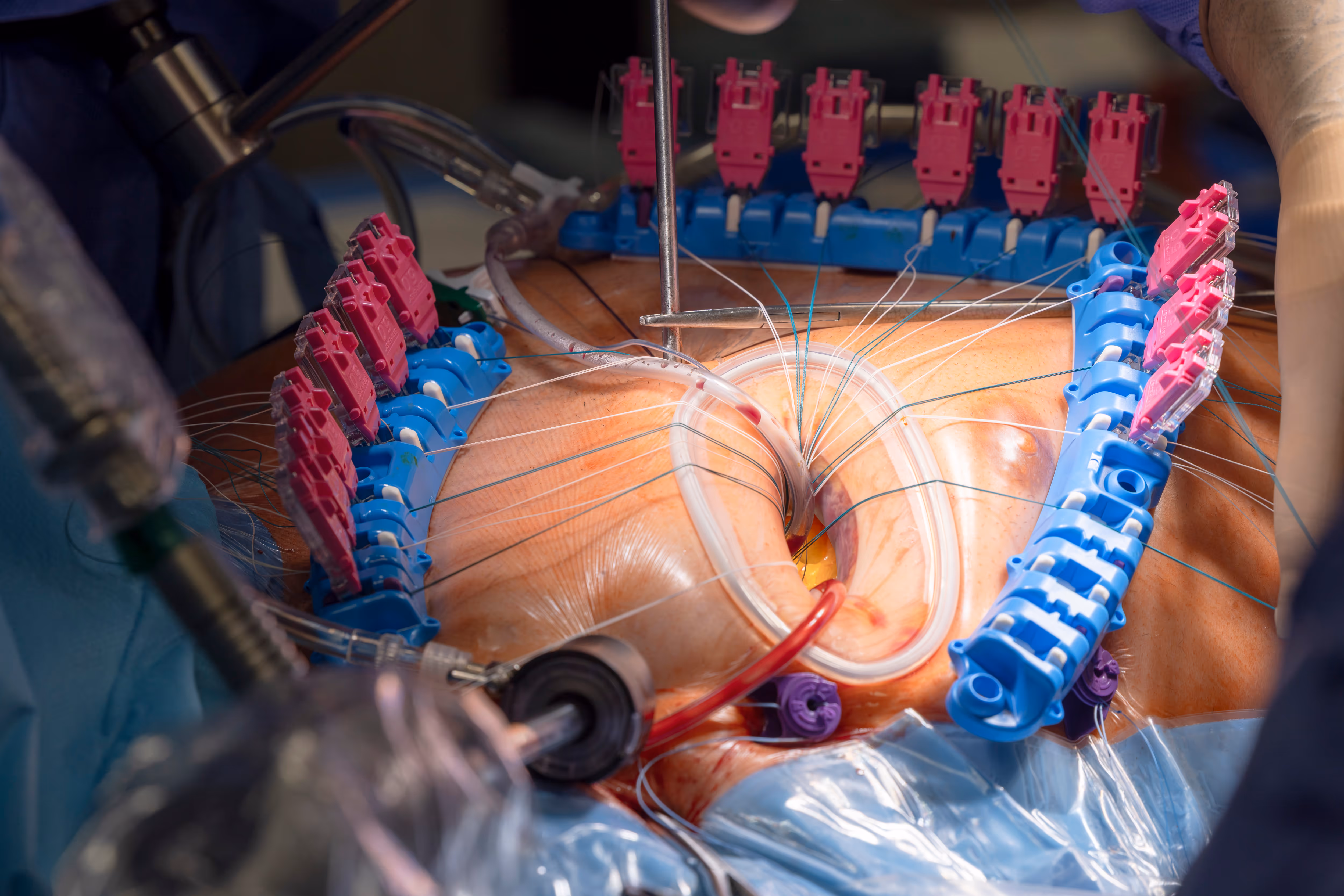 MVR Suture Management RAM Racks